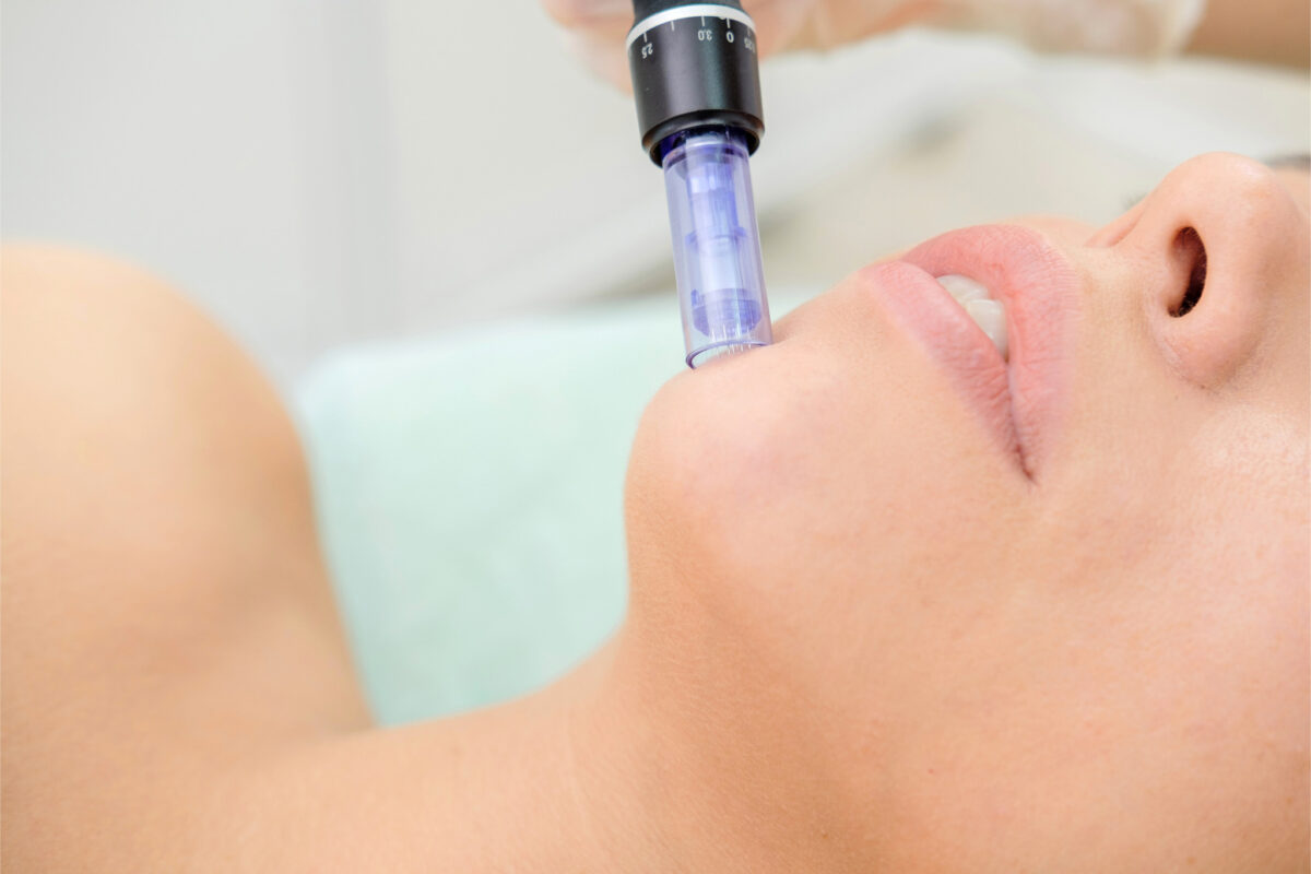 ANEOMED Aesthetics Microneedling Behandlung Luzern Kosmetikstudio Schweiz